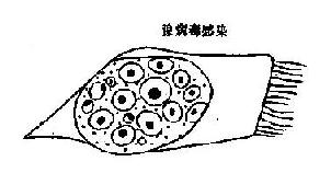 病毒感染时,痰涂片中的细胞内包涵体