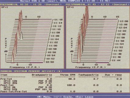快速富里叶(Fourier)分析法进行EGG检查图例