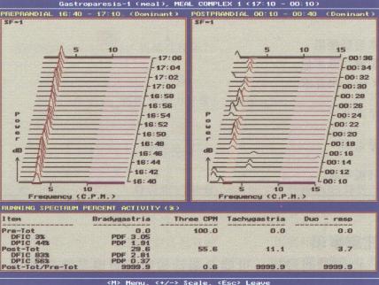 快速富里叶(Fourier)分析法进行EGG检查图例