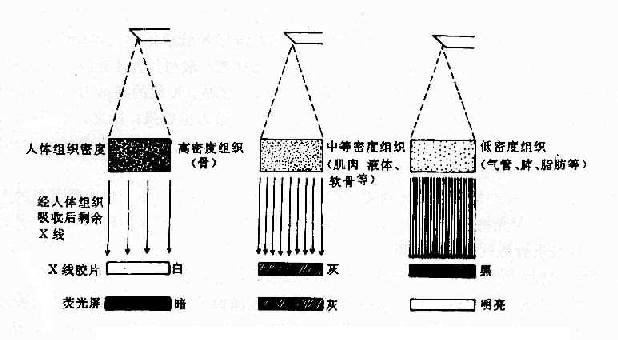 不同密度组织(厚度相同)与X线成像的关系